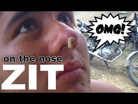 HUGE MEGA ZIT ON THE NOSE / POPPING ZIT - Top Pimples