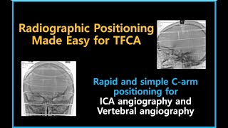 [뇌혈관조영술] 신속 간단하게 뇌혈관조영 촬영 위치 잡기 Swift and simple radiographic positioning for TFCA