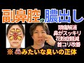 【鼻の奥が腐ってる!?】10年溜まった鼻の膿を7日で出す方法|頭痛・副鼻腔炎
