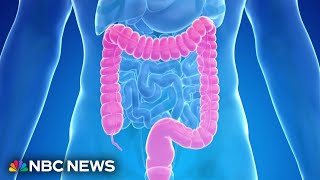 New blood test is added an an option for colorectal cancer screenings