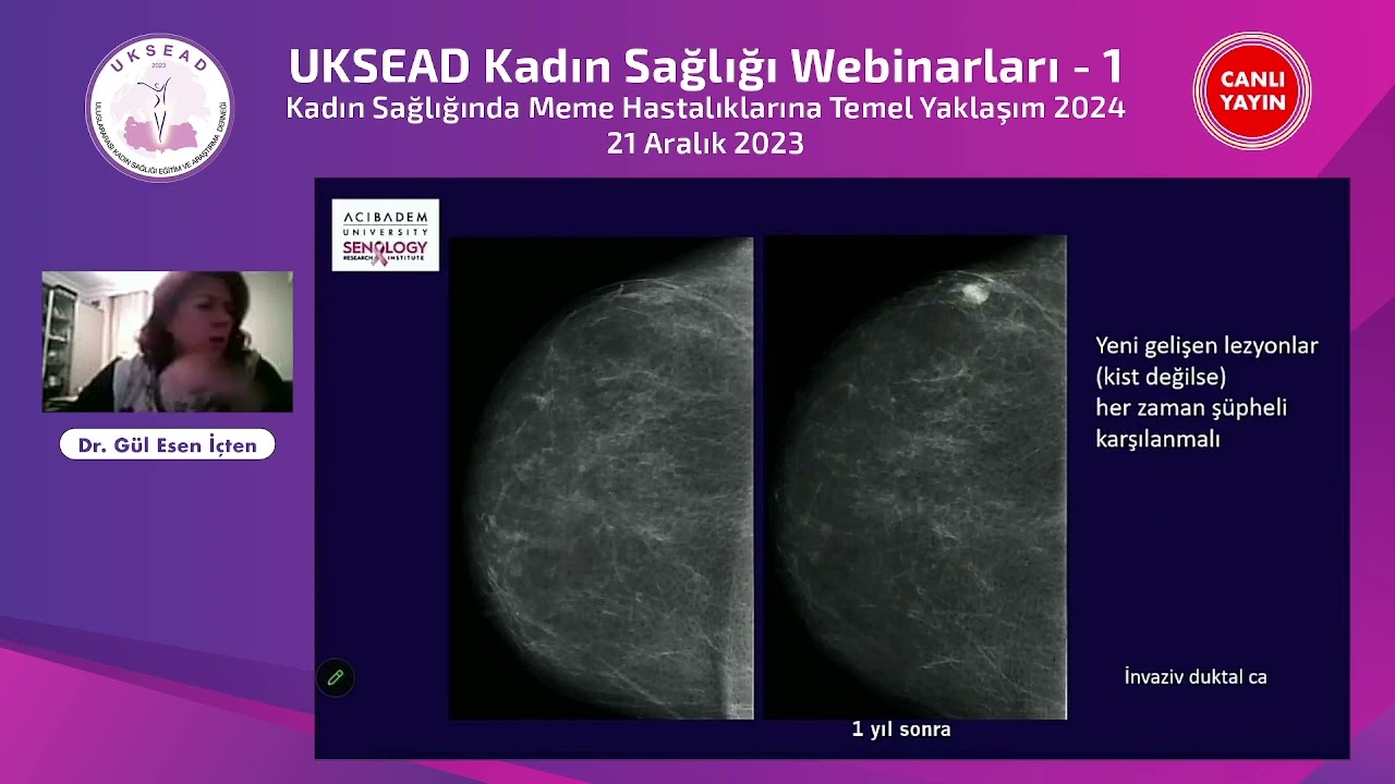 UKSEAD Kadın Sağlığı Webinarları 1- Kadın Sağlığında Meme Hastalıklarına Temel Yaklaşım 2024