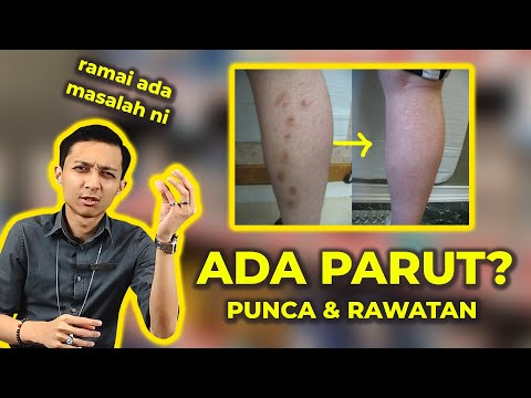 PUNCA PARUT GELAP DAN CARA RAWATAN