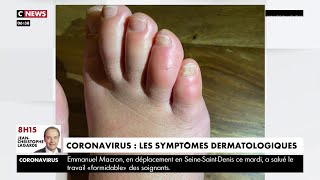 Coronavirus : les dermatologues alertent sur de nouveaux symptômes cutanés
