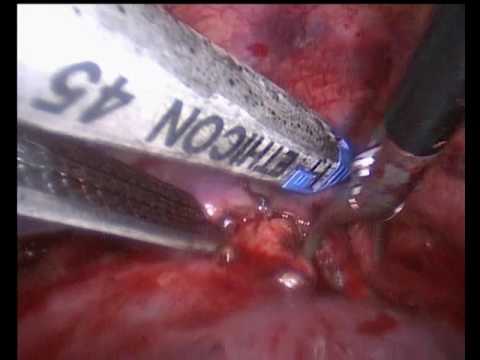 Торакоскопическая мобилизация пищевода (РНЦХ)