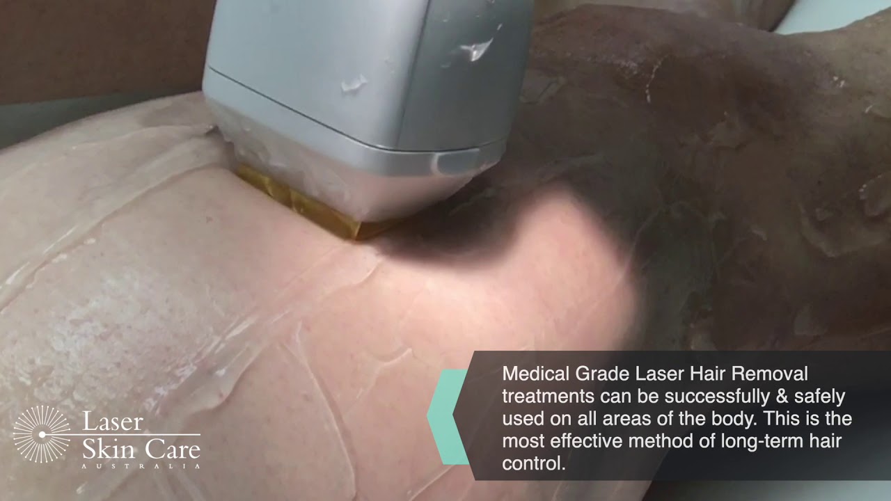 Medical Grade Laser Hair Removal Treatment. YouTube