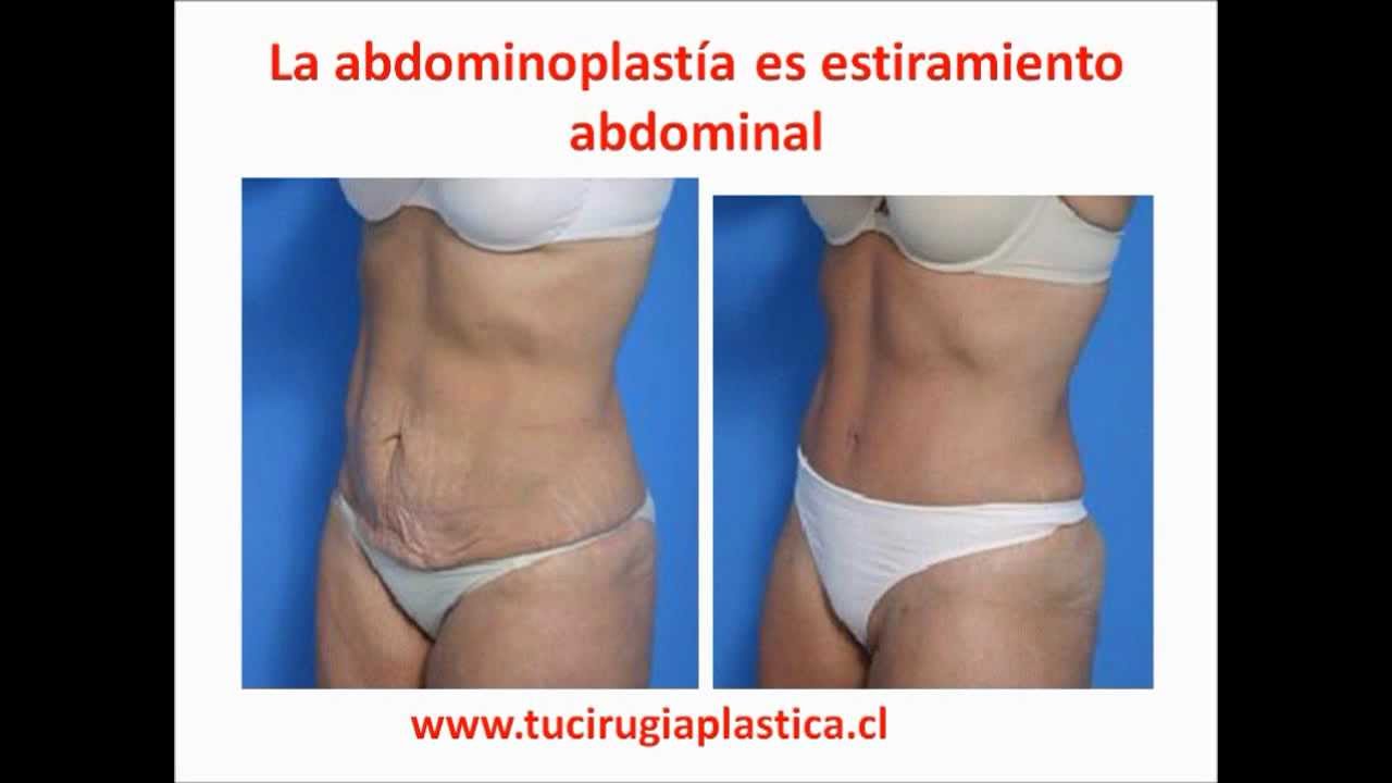 Valor De Abdominoplastia