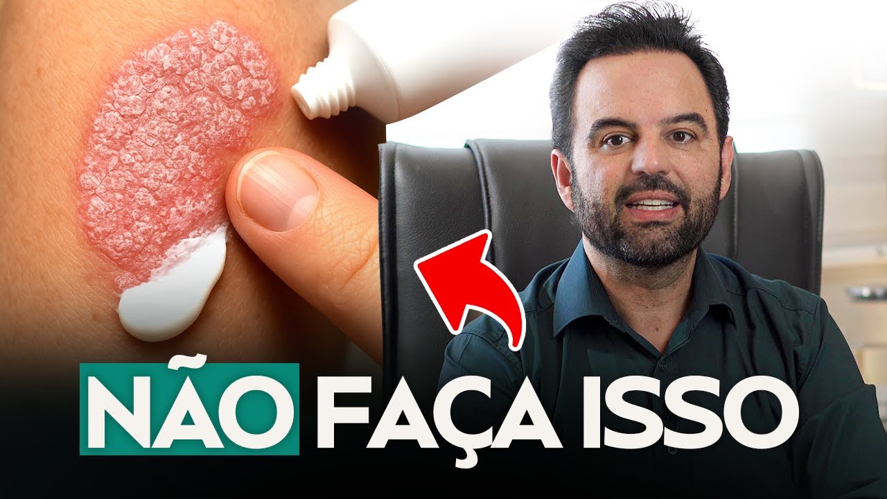 Você está tratando PSORÍASE errado e pode piorar tudo!
