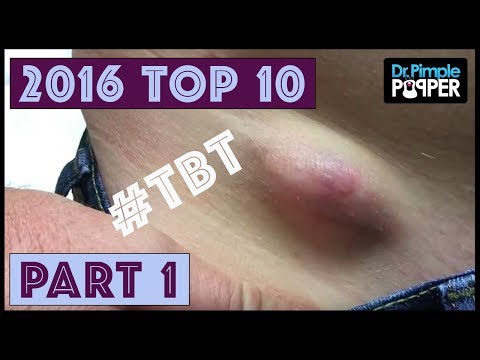 Remembering DrPimplePopper's TOP 10 POPS of 2016, Part 1