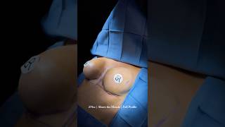 Breast Augmentation | Houston, Tx | Body By Ravi Plastic Surgery