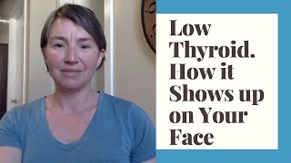 How Low Thyroid (Hypothyroid) Shows up on Your Face