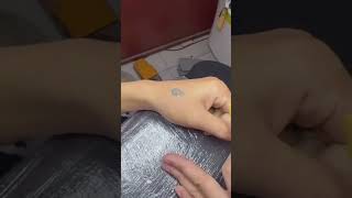 احدث تقنيات إزالة الوشم بالليزر Laser Tattoo Removal