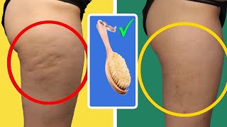 How To Get Rid Of Cellulite: 5  Home Remedies