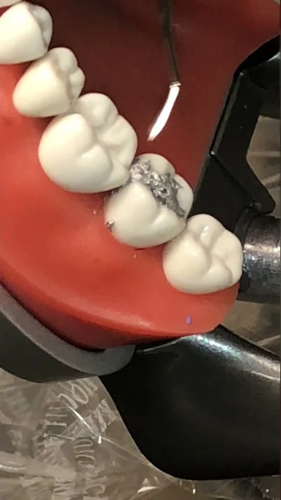 18 MO Amalgam, Occl finding margins