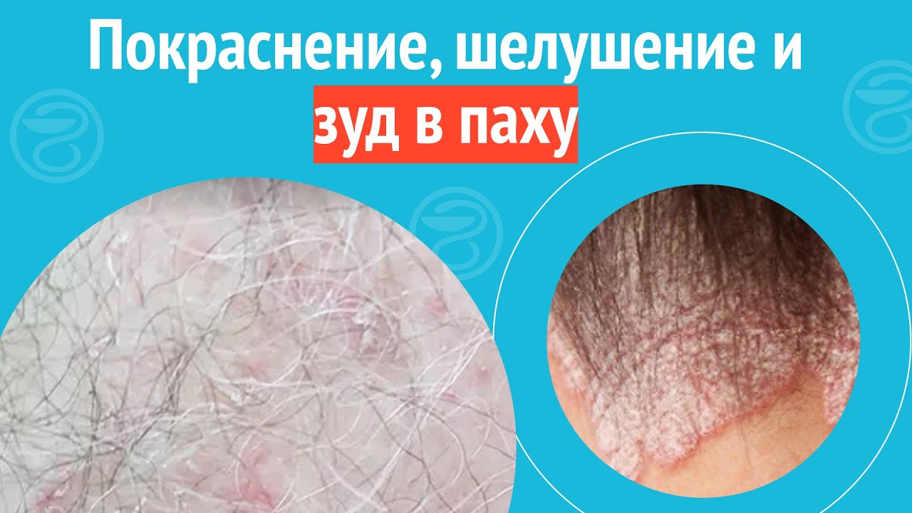 😟 Покраснение, шелушение и зуд в паху. Клинический случай №1154