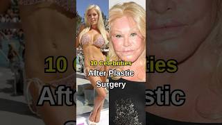 Celebrities Before & After Plastic Surgery Then And Now