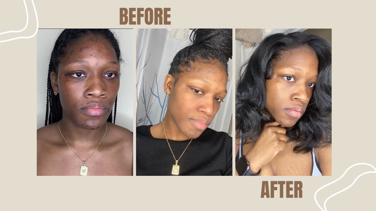 How I Cleared My Skin In 3 Months - YouTube