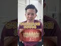 【ビフォーアフター】保険治療で安定した入れ歯作れます!【入れ歯】