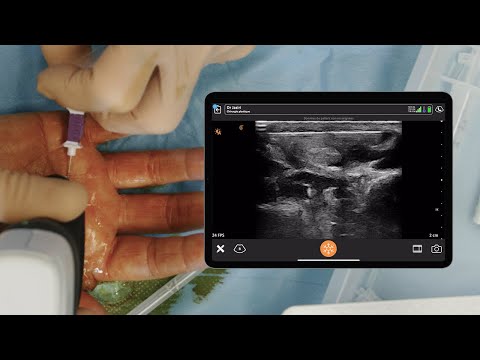 Image of WALANT for Palmar Tumor Surgery