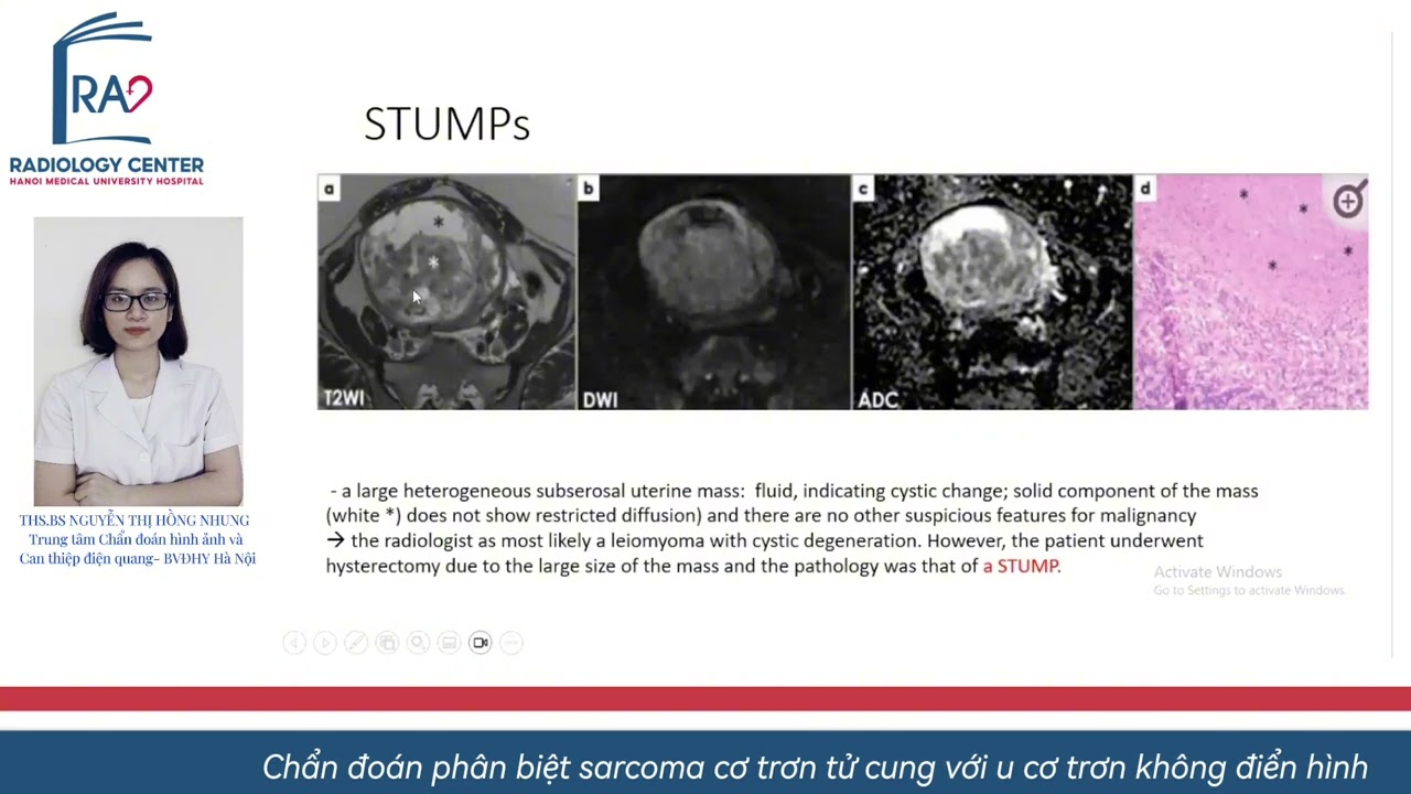 CHẨN ĐOÁN PHÂN BIỆT SARCOMA CƠ TRƠN TỬ CUNG VỚI U CƠ TRƠN KHÔNG ĐIỂN HÌNH