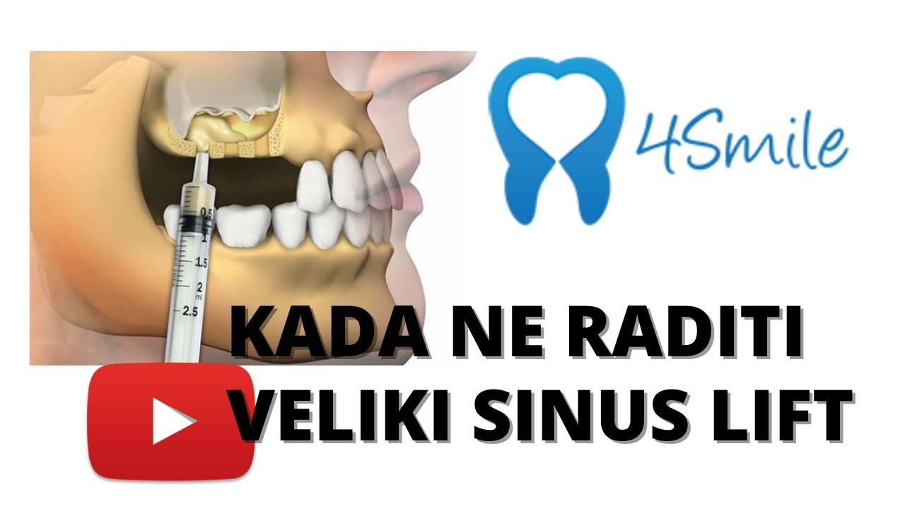 Kada Ne Raditi Veliki Sinus Lift - Podizanje Sinusa - Dental Centar 4Smile