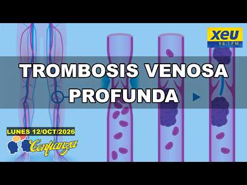 Trombosis venosa profunda: síntomas, riesgos y prevención