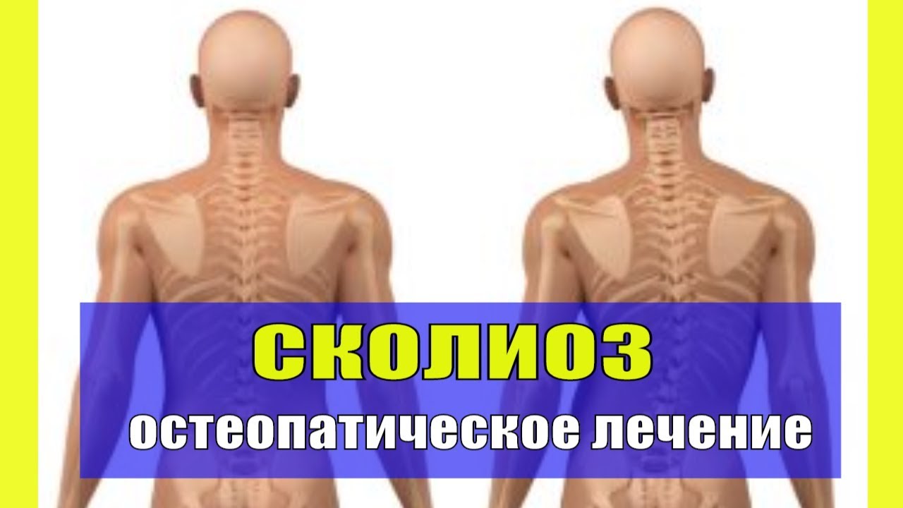 Как лечить сколиоз Остеопатический подход - YouTube