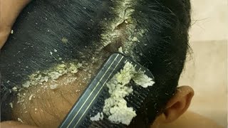 [Big Flakes] Dandruff Scratching || Satisfying Video # 1006