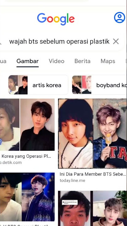 wajah bts sebelum operasi plastik