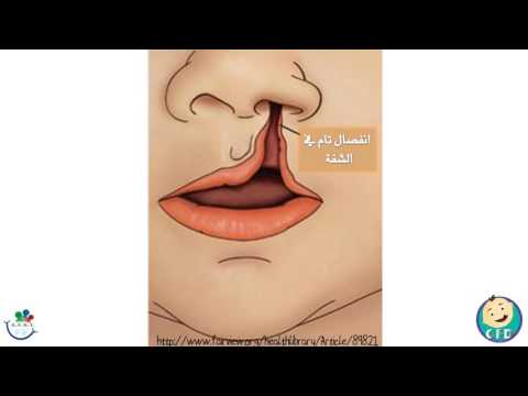 شق الشفاه وسقف الحلق  Cleft Lip & Palate