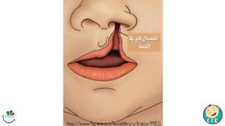 شق الشفاه وسقف الحلق  Cleft Lip & Palate