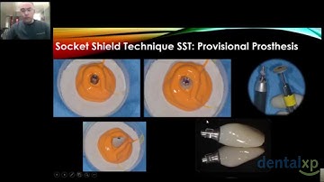 The Socket Shield Technique; Myths & Realities