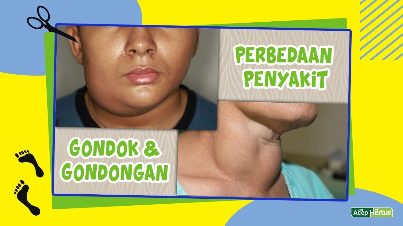 Perbedaan Gondok Dan Gondong Penyakit Imagesee