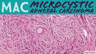 Microcystic Adnexal Carcinoma Mac 5-Minute Pathology Pearls