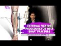 External Fixator Procedure For Tibia Shaft Fracture