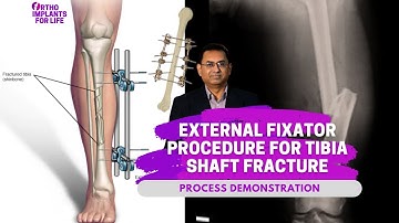 External Fixator Procedure For Tibia Shaft Fracture