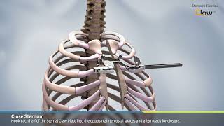 Waston sternum fixation