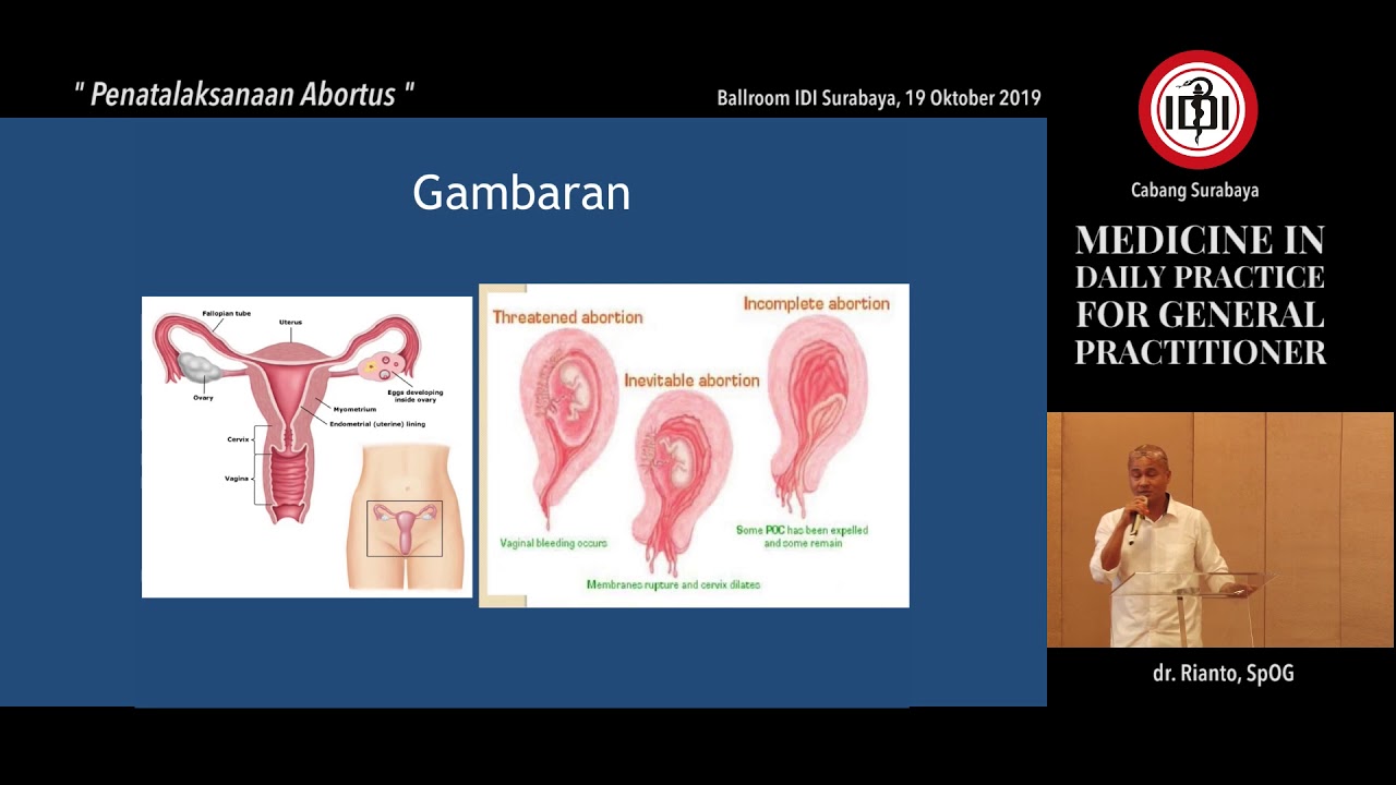 005 Penatalaksanaan Abortus dr. Rianto, SpOG
