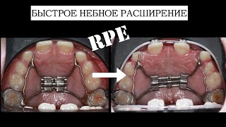 : Rapid palatal expansion:  / RPE (English subtitles)