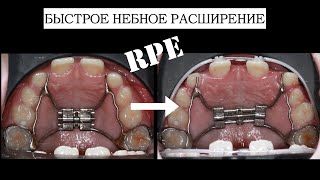 Rapid palatal expansion:Быстрое небное расширение/ RPE (English subtitles)