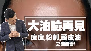 大油臉再見一周控油改善痘痘、粉刺、頭皮油【77老大】