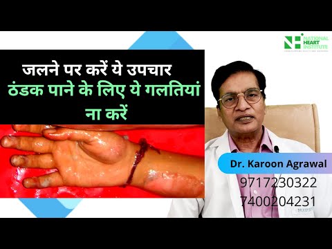 जलने पर करें ये उपचार | Jalne ka Ilaaj in Hindi | Dr. Karoon Agrawal