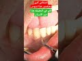 جير الاسنان تحت اللثه Dental Plaque 