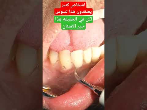 جير الاسنان تحت اللثه  