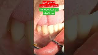 جير الاسنان تحت اللثه||dental plaque
