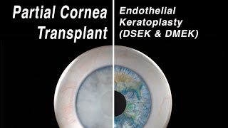 Selective Cornea Transplant  Endothelial Keratoplasty (DMEK, DSEK)