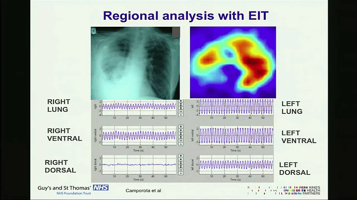 Eelectrical Impedance Tomography by Dr Luigi Camporota MD, PhD, MRCP, FFICM.