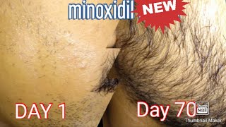 I Grew Out My Beard For 70 Days Using Minoxidil Mintop 5%