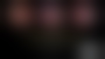 Fissureless LUL (Common Pulmonary Vein)