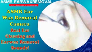 ASMR Ear Wax Removal Camera – Real Ear Cleaning and Earwax Removal Sounds!