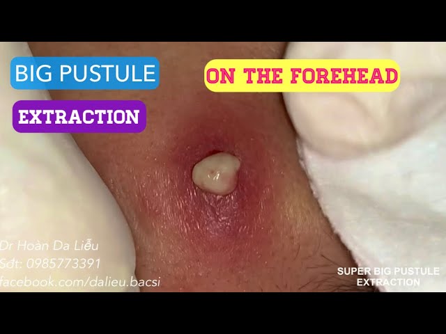 Mụn mủ siêu to trên trán|Dermatologist,pimples,whitehead,acne conglobata, big pustule extraction